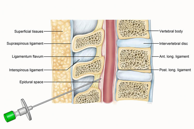 Minimally Invasive Procedures Epidural Injections Facet Blocks