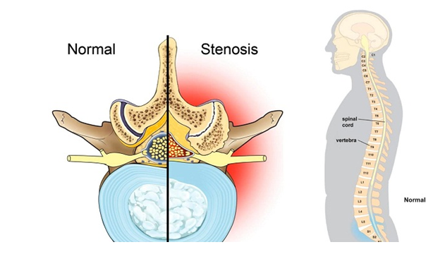 What is Spinal Stenosis? 