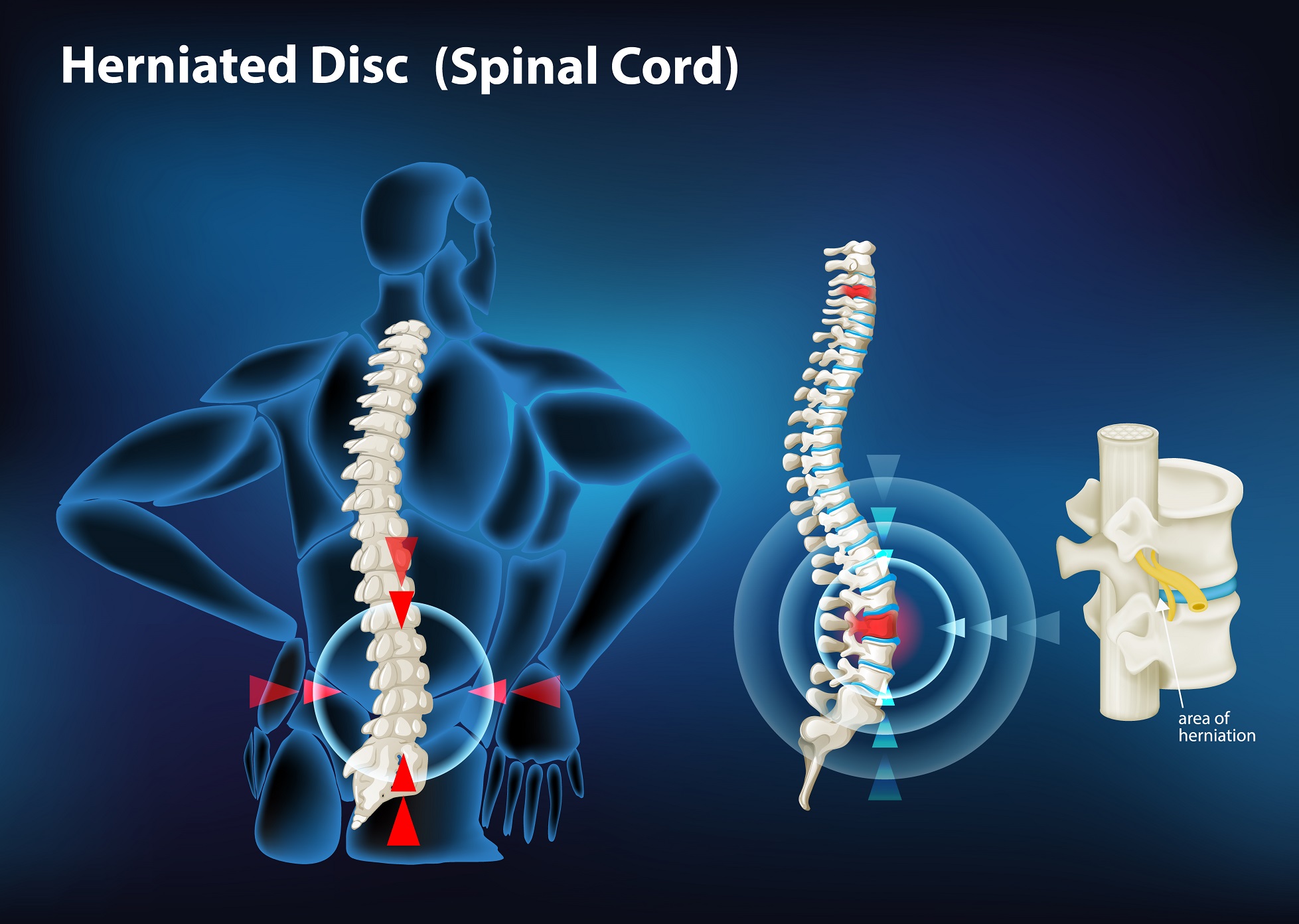 Herniated Disc        