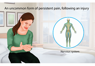 Complex Regional Pain Syndrome     