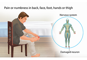 Peripheral Neuropathy       