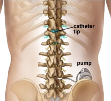 Intrathecal Pump     